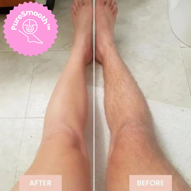 LaserSchlösser™ Stärkt die Haarwurzeln
